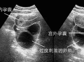 女性有染色体罗氏易位在湖州市做试管养囊成功率高吗？试管移植后需要保胎吗！